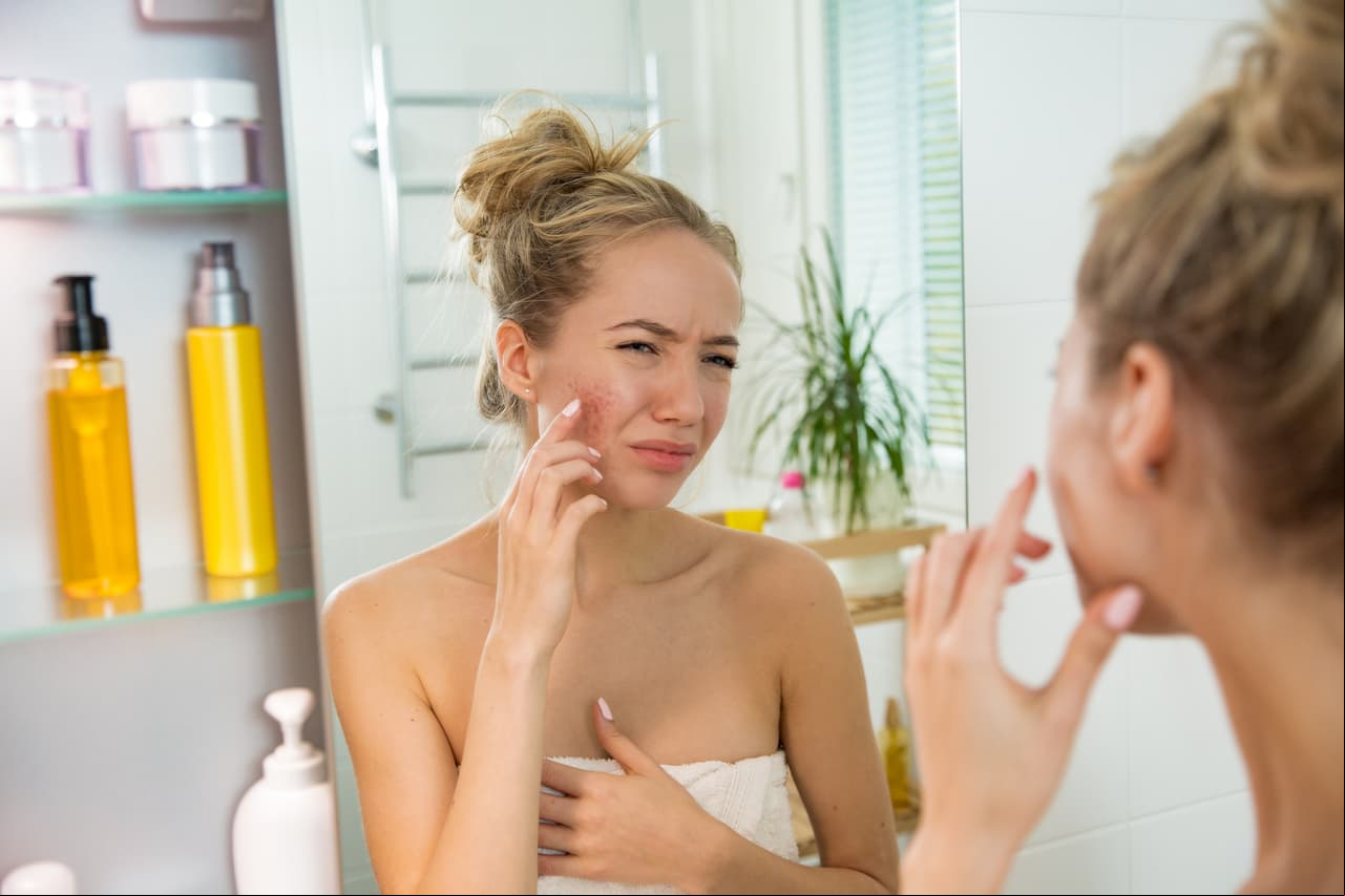 Piel. El té verde permite que tu rostro esté libre de manchas, arrugas y acné.