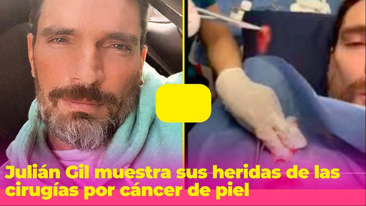 Julián Gil muestra sus grandes heridas de las cirugías por cáncer de piel