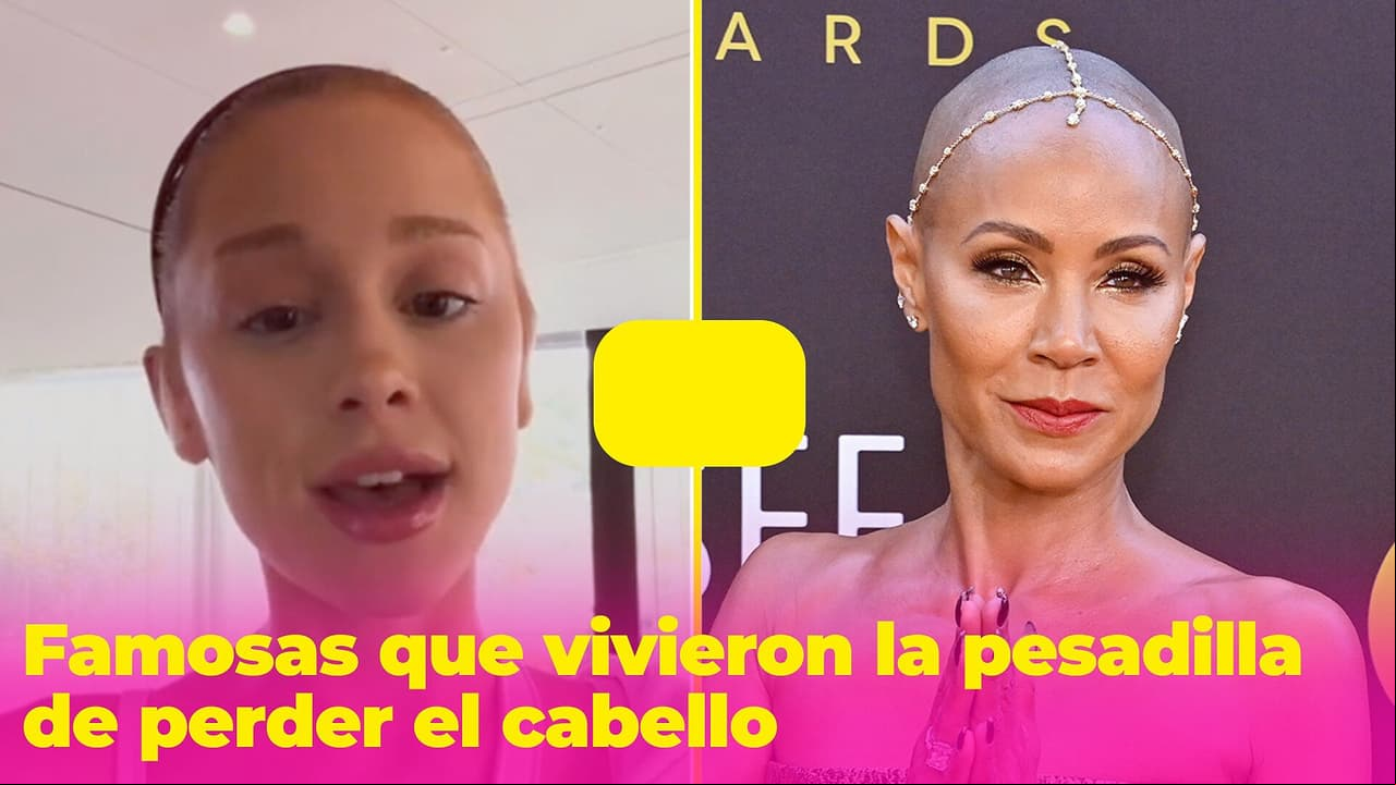 Estas famosas vivieron una pesadilla al perder su cabello, pero fueron valientes y revelaron su problema